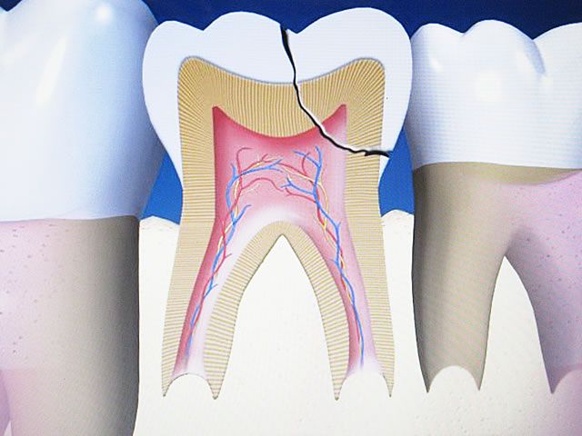 Zahnunfall - Zahn abgebrochen